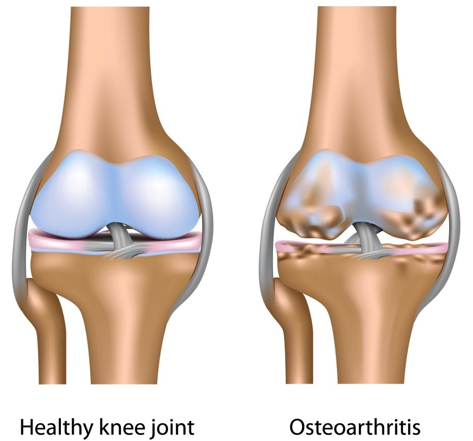 Osteoarthritis-of-Knee-Joint