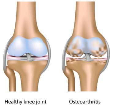 Osteoarthritis-of-Knee-Joint